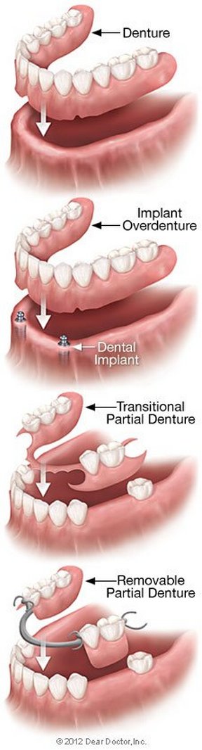 types of dentures in Bellmore, NY