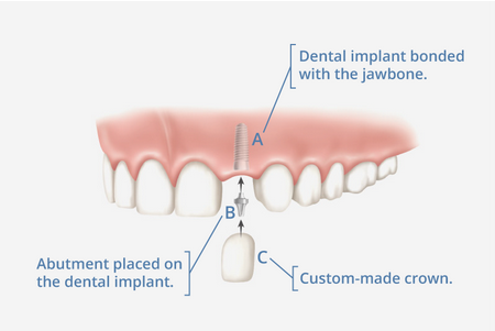 diagram of implant being placed in jawbone, Dental Implants Katy, TX dentist