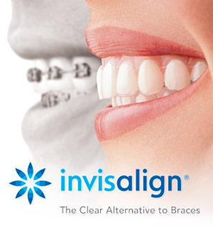 Invisalign logo and two mouths side by side, one wearing braces one wearing Invisalign Katy, TX