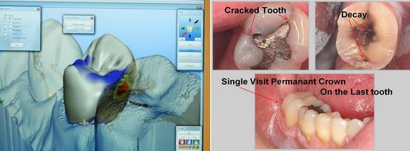 Experience CEREC (one visit crowns) Technology!