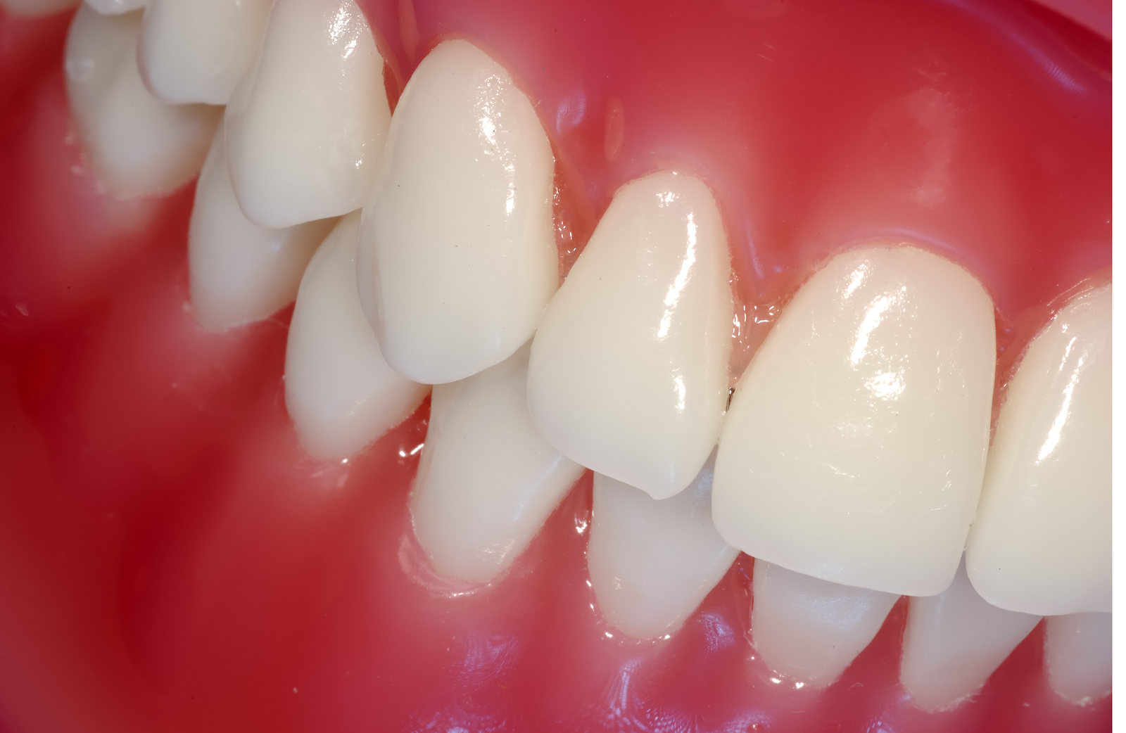 teeth whitening in Atchison KS