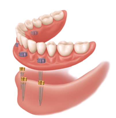 Stockton Dental Implants