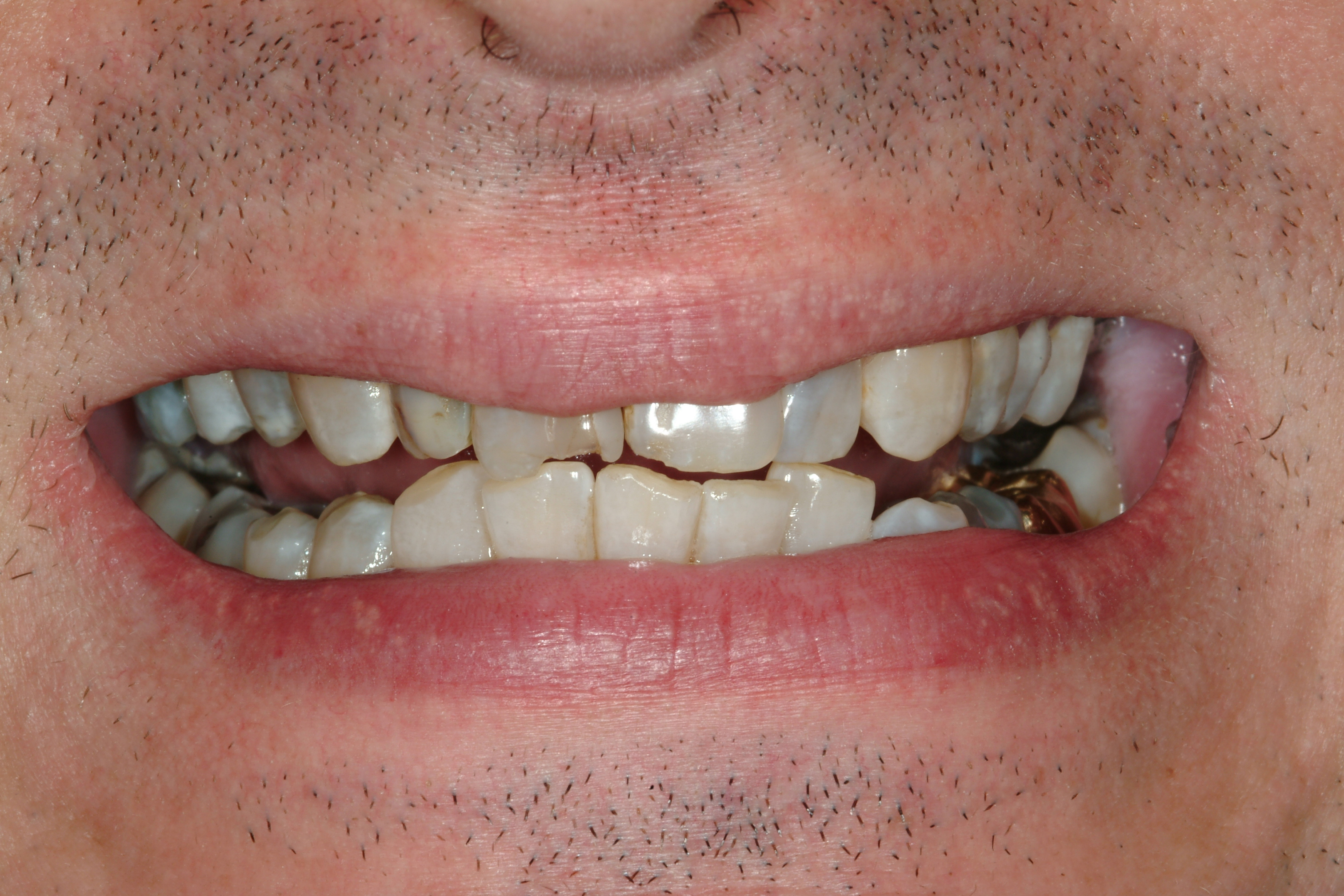 Wilsonville dental patient before treatment