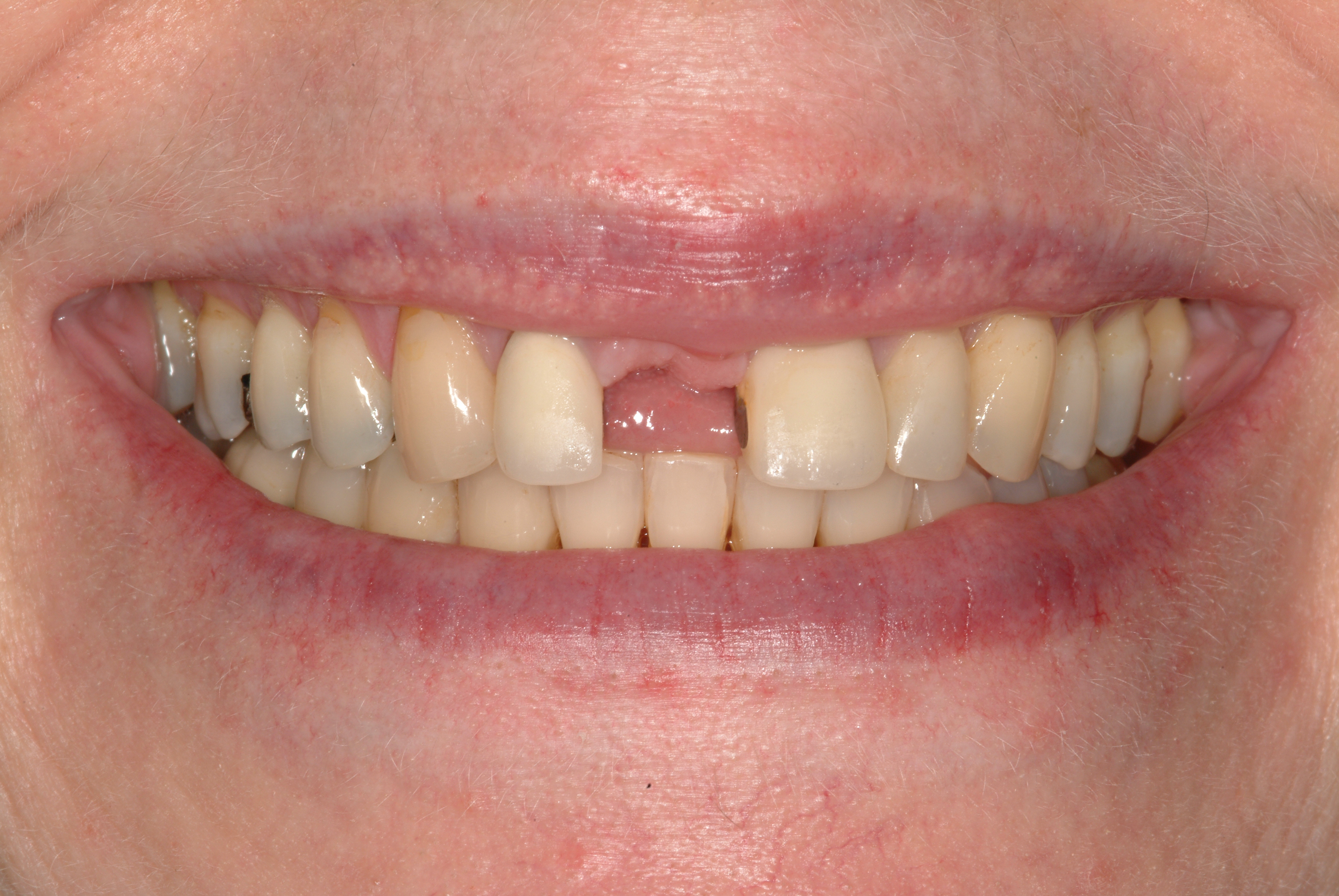 Before treatment by Wilsonville dentist