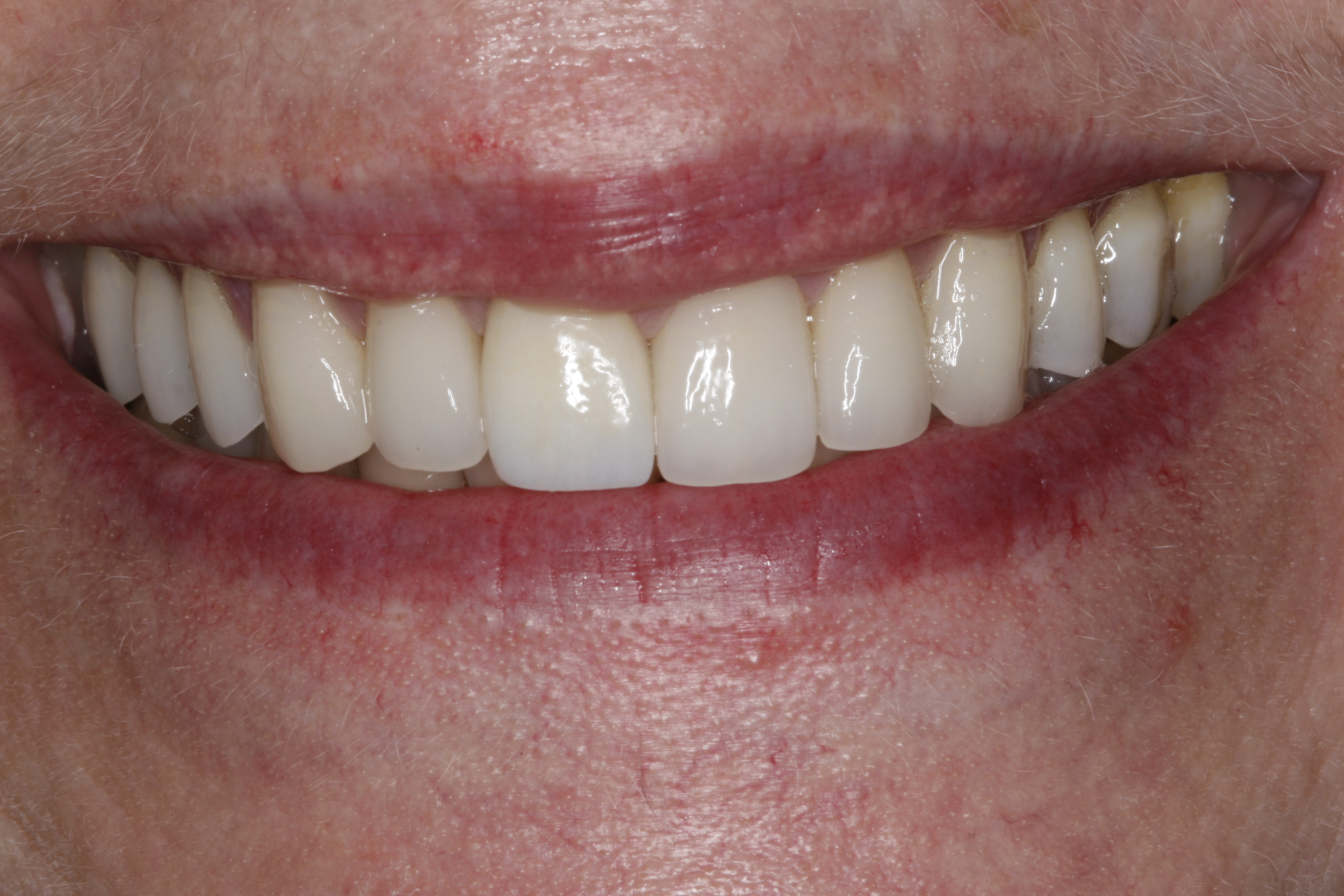 After treatment by Wilsonville dentist