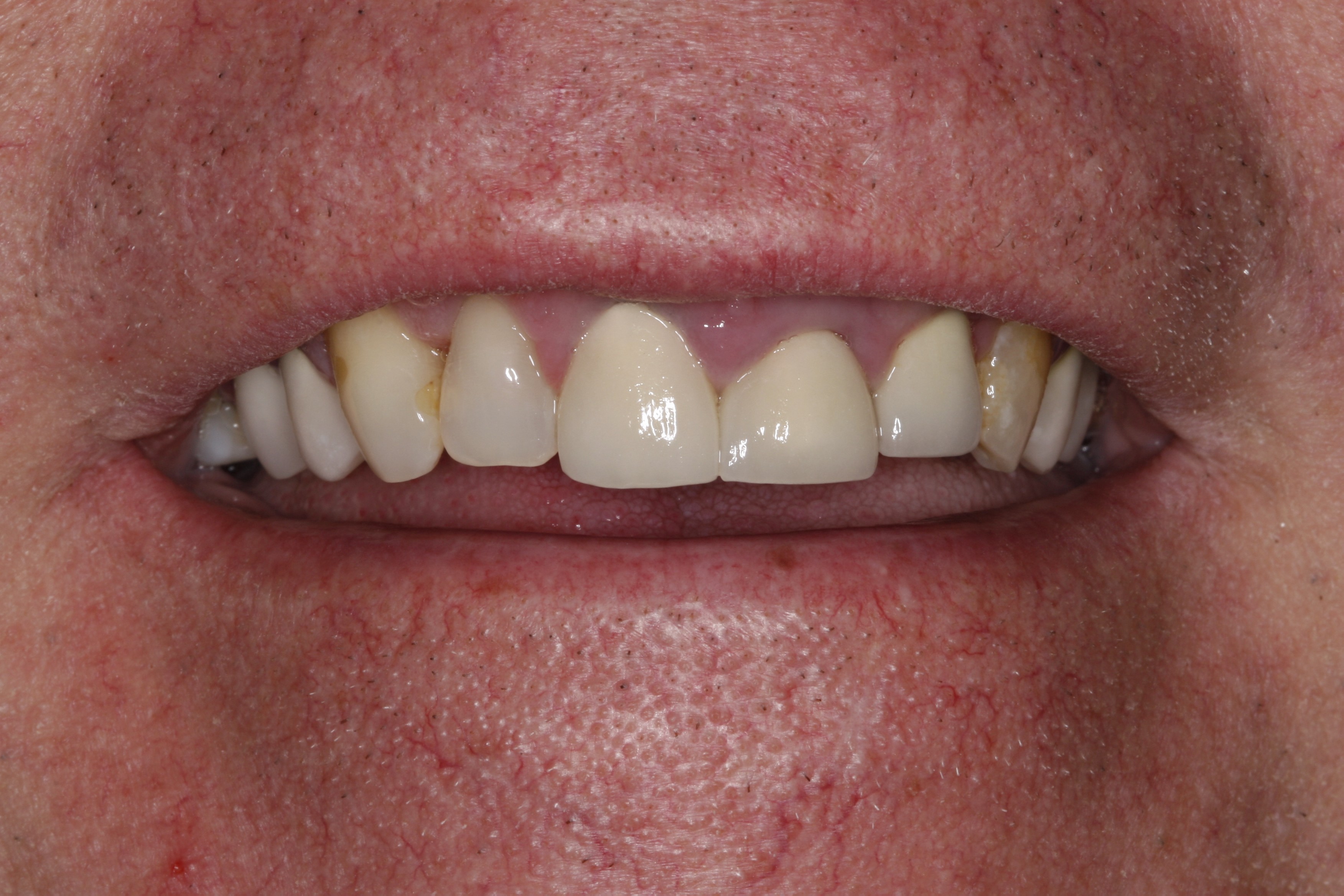 Before treatment by dentist in Wilsonville