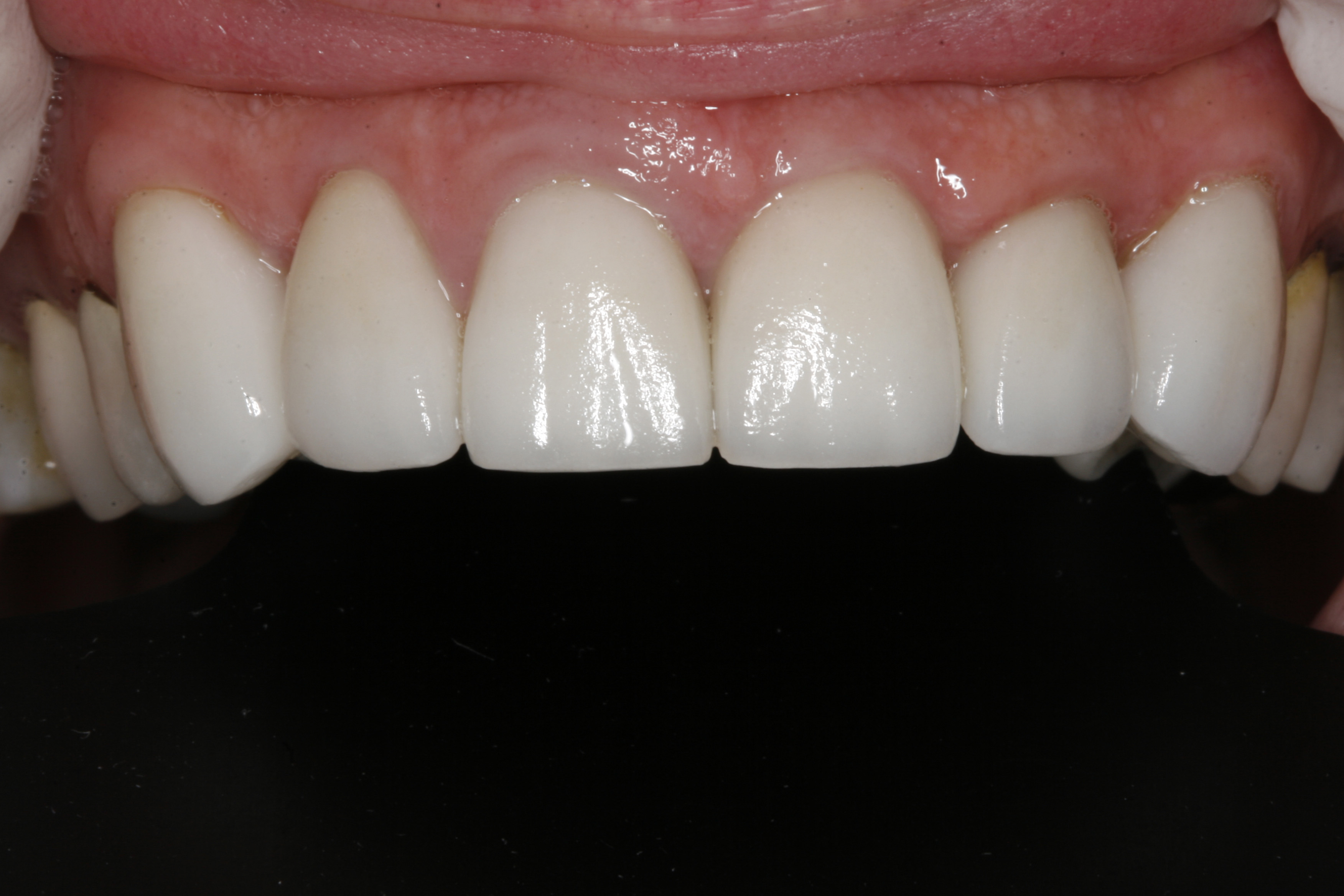 After treatment by dentist in Wilsonville