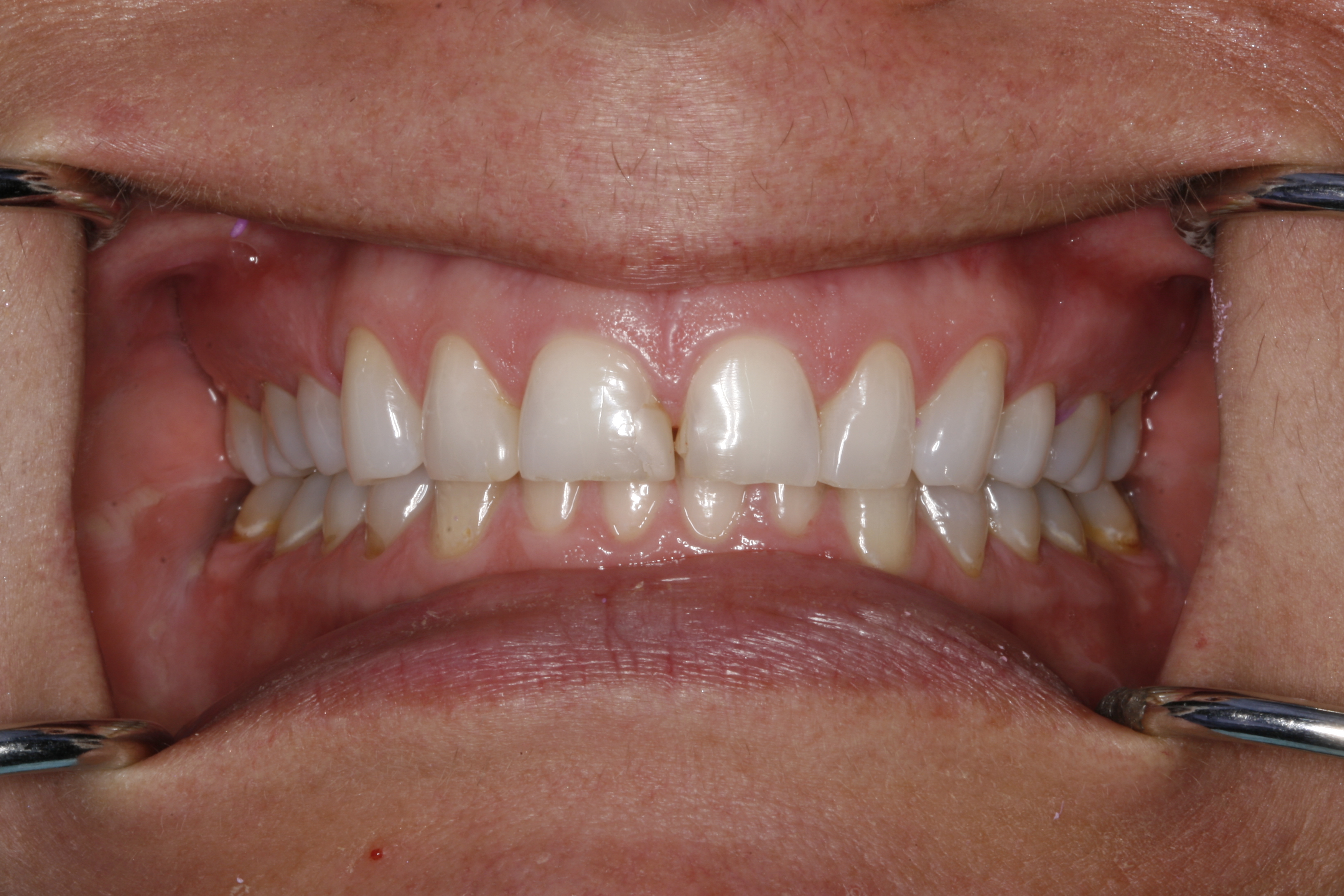 Before Wilsonville OR dental treatment