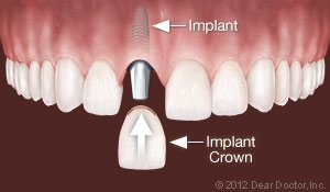 Replace One Tooth dental implants West Orange, NJ