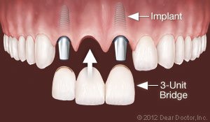 Replace Multiple Teeth dental implants West Orange, NJ