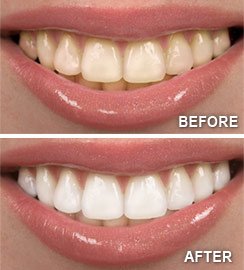 before and after results Teeth Whitening West Orange, NJ