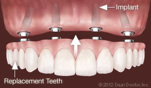 Replace All Teeth Permanently dental implants West Orange, NJ
