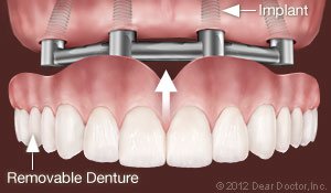 Removable Dentures supported by dental implants West Orange, NJ