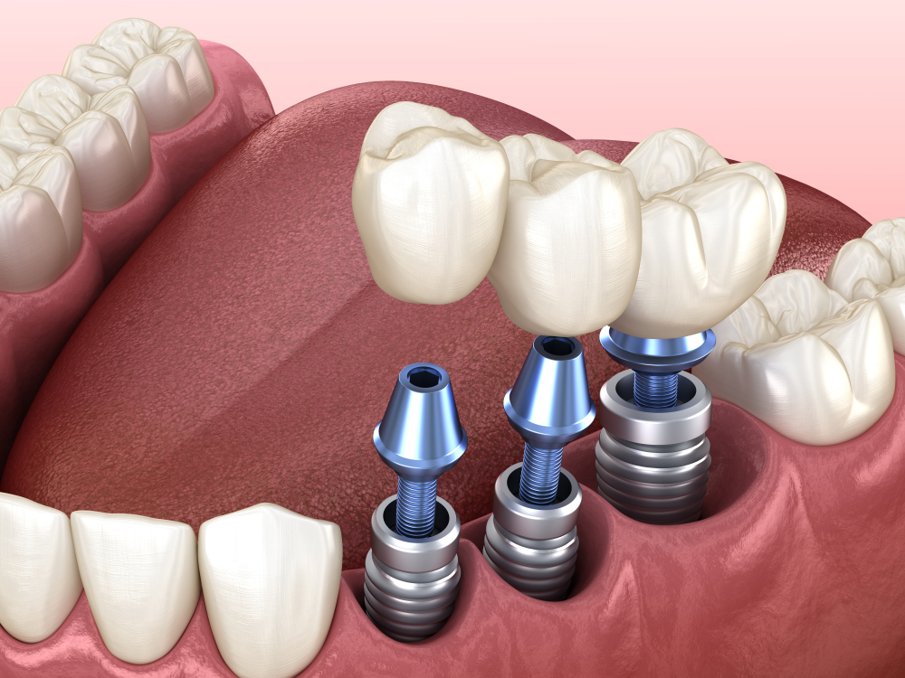illustration of mouth and teeth with Dental Implants West Orange, NJ