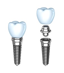 Dental Implants Riverview FL | Dentist