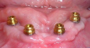 Dental Implant posts Bridgeport Fairfield