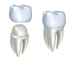 illustration of crown fitting over tooth, dental crowns Marlboro, NJ
