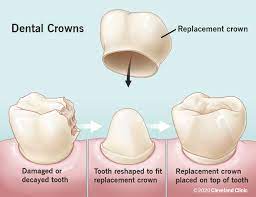 Diagram of Dental Crowns, Cary, NC
