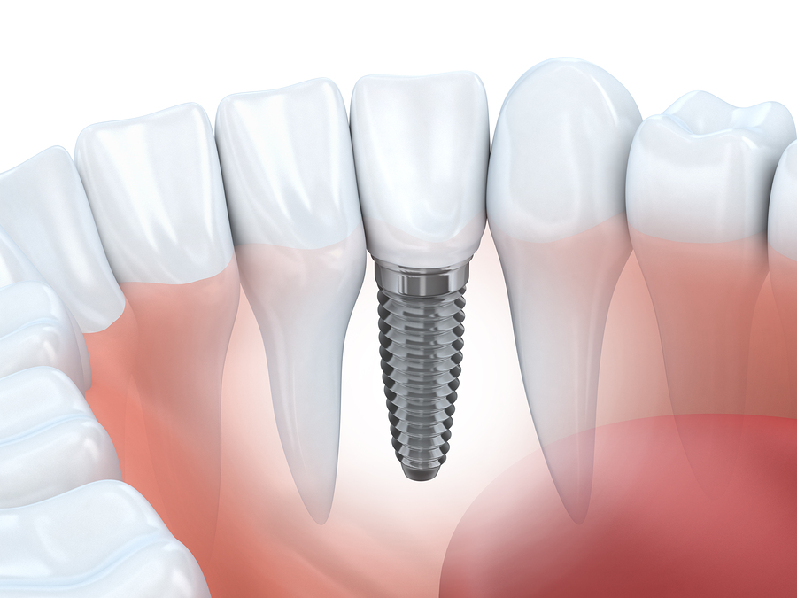 illustration of dental implant embedded into jaw with natural teeth, dental implants Plantation, FL implant dentistry