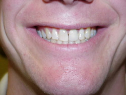 man's smiling mouth showing teeth before Porcelain Veneers Downtown San Diego, CA