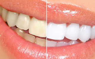 close up of smiling mouth showing before and results of professional teeth whitening San Diego, CA dentist