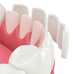 3D computer illustration of lower arch of teeth, porcelain veneer pieces floating in front of teeth, dental veneers Windsor Locks, CT dentist