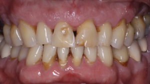 dental-veneers01.png