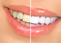 before and after results professional teeth whitening Tarzana, CA