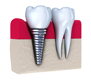 illustration of real tooth roots next to dental implants Tarzana, CA