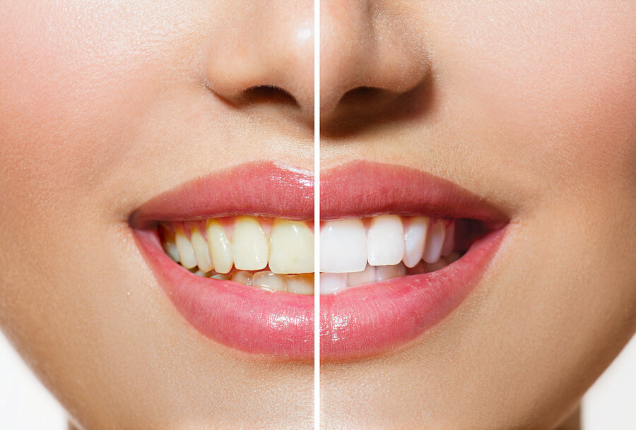 before and after image of whitening results on woman's teeth after professional teeth whitening Old Bridge, NJ dentist