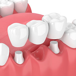 3D computer illustration of dental bridge with three crowns being placed over abutment teeth, dental crowns and bridges Old Bridge, NJ dentist