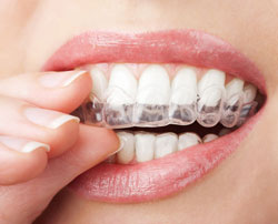 hand holding clear teeth aligners in mouth