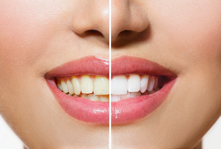 Photograph of woman's smile showing before and after teeth whitening in West Palm Beach, FL