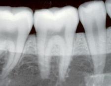 Waukesha dental x-rays