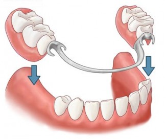 Partial dentures at Baye and Fahl Waukesha